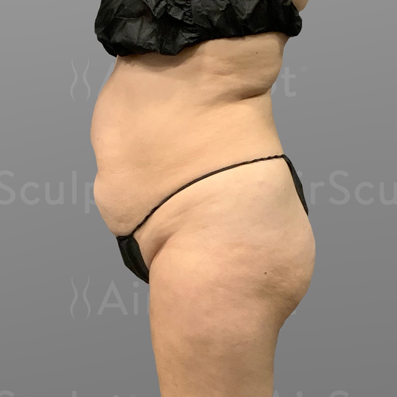 before Back Bra Roll, Lower Back, Full Ab, BBL AirSculpt
