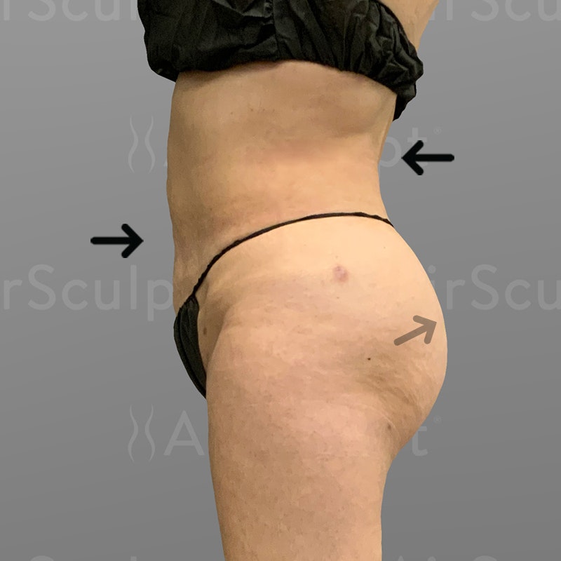 after Back Bra Roll, Lower Back, Full Ab, BBL AirSculpt