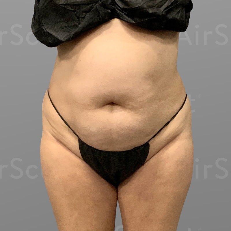 before Back Bra Roll, Lower Back, Full Ab, BBL AirSculpt
