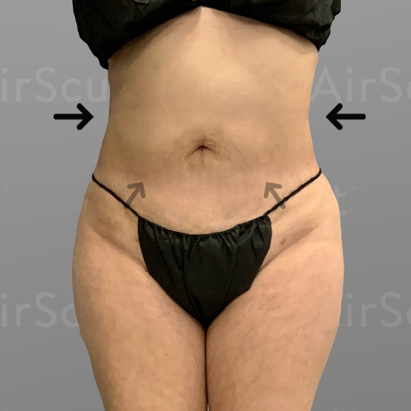 after Back Bra Roll, Lower Back, Full Ab, BBL AirSculpt