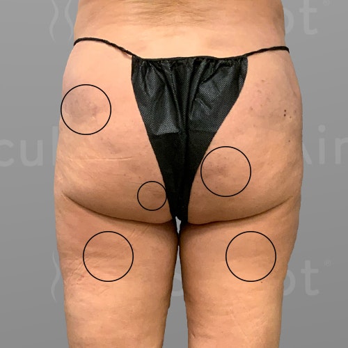 LeeAnne Before 1 month airsculpt