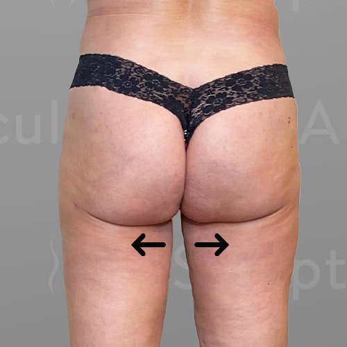 LeeAnne After 1 month airsculpt