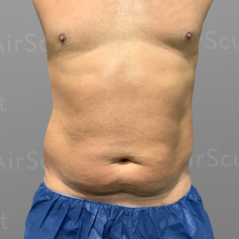 Six Pack Abs Tampa  BodySculpting Liposuction Clearwater