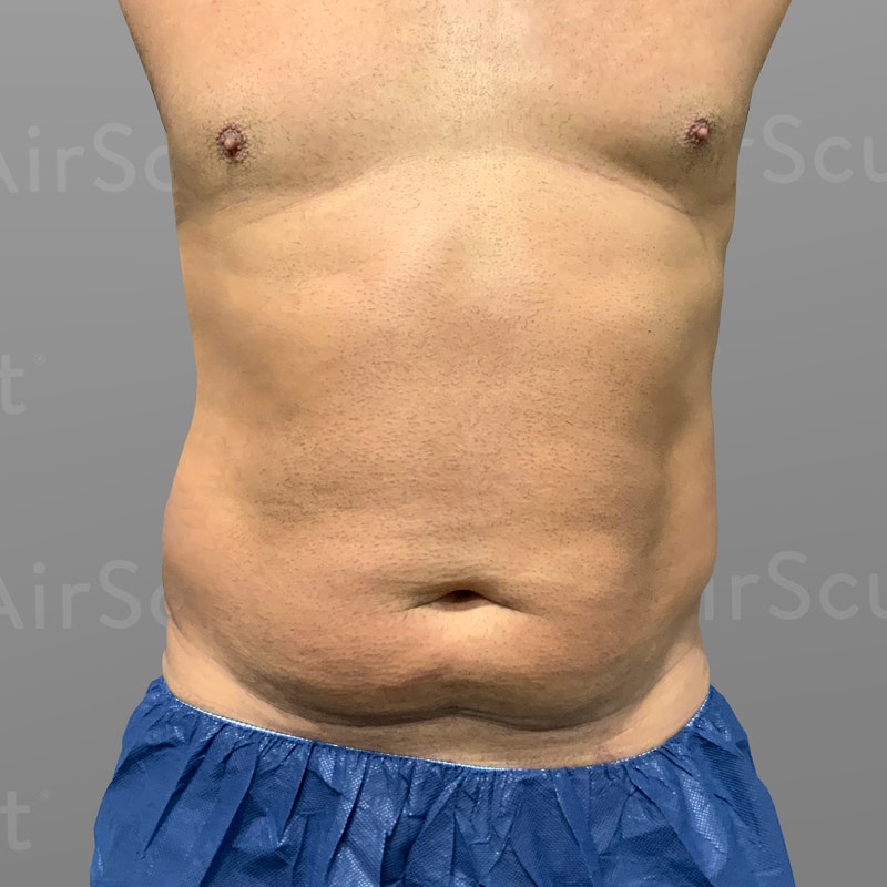 before 48 hour six pack airsculpt