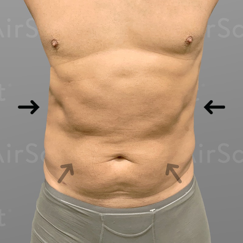 after 48 hour six pack airsculpt