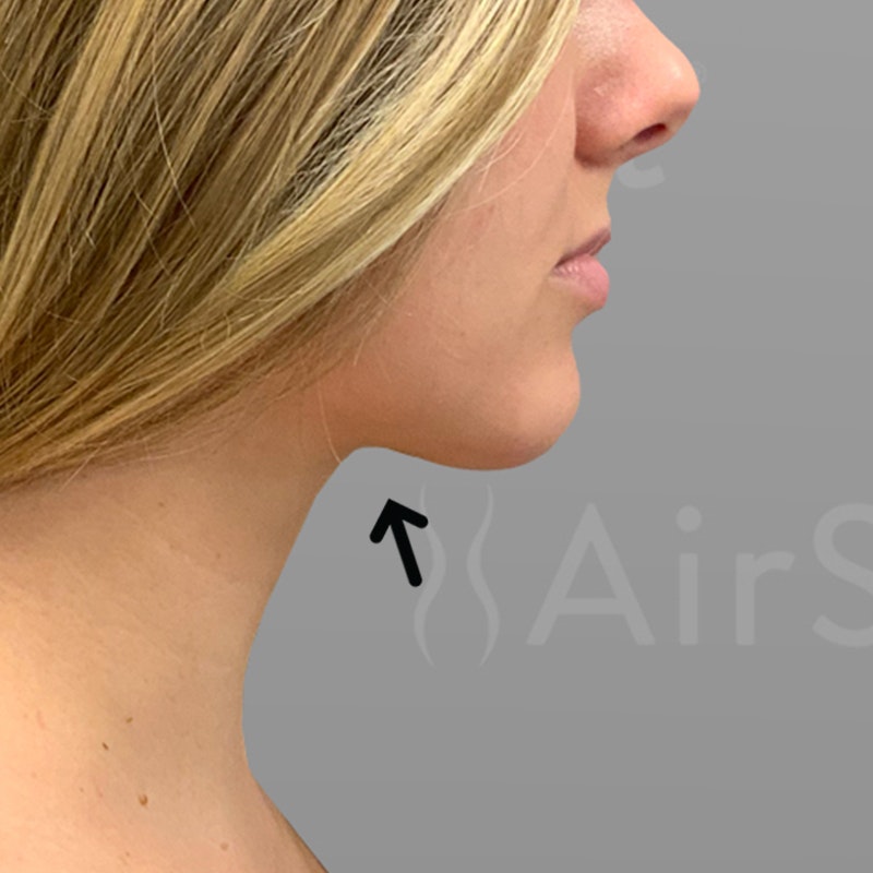 after Chin AirSculpt