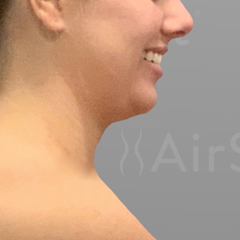 before Chin AirSculpt