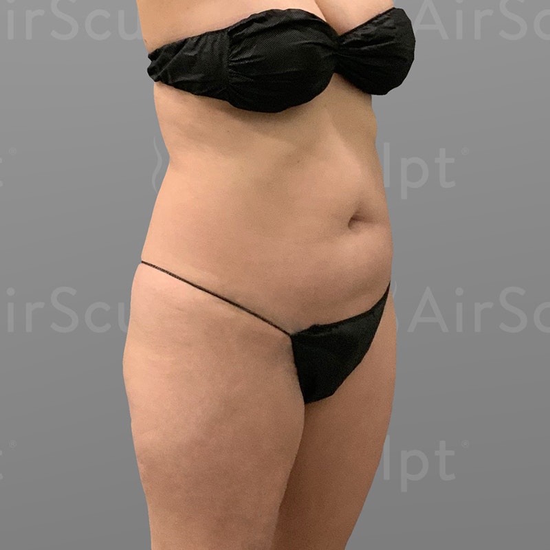before Stomach and BBL AirSculpt
