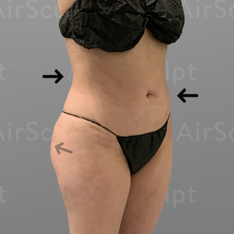 after stomach and BBL AirSculpt