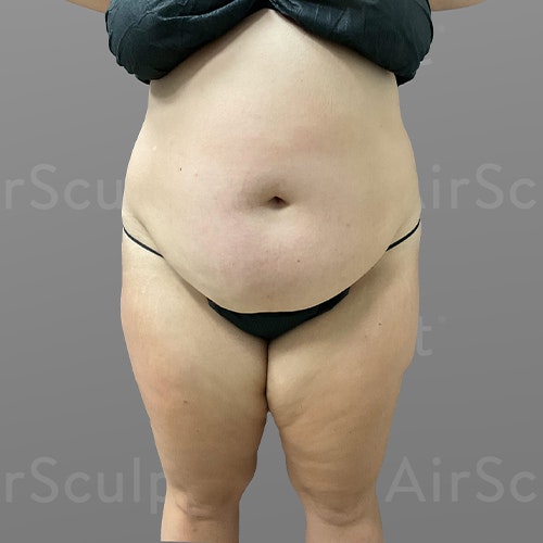 before stomach AirSculpt