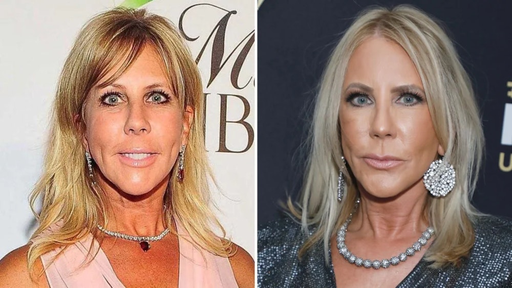 RHOC’s Vicki Gunvalson Has Been Open about Her Plastic Surgery Journey