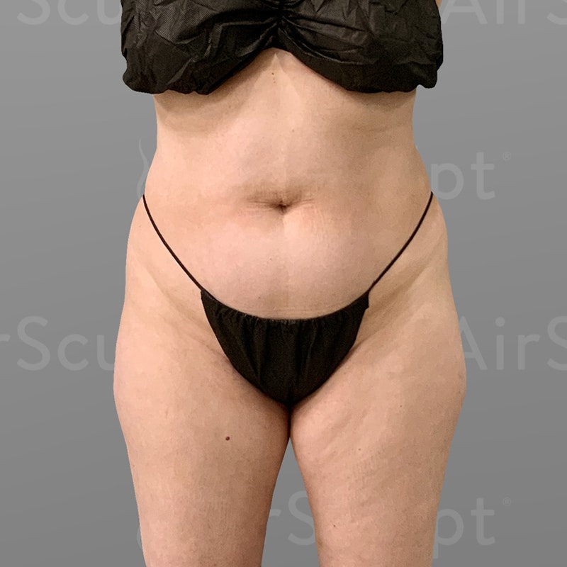 before stomach AirSculpt