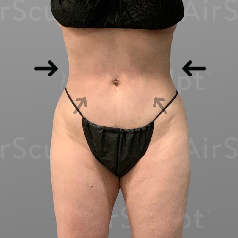 after stomach AirSculpt