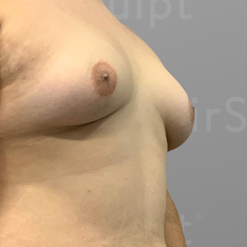before male chest reduction airsculpt
