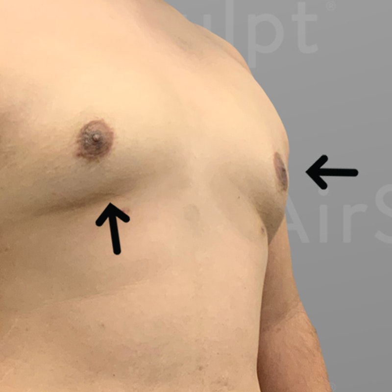 after male chest reduction airsculpt