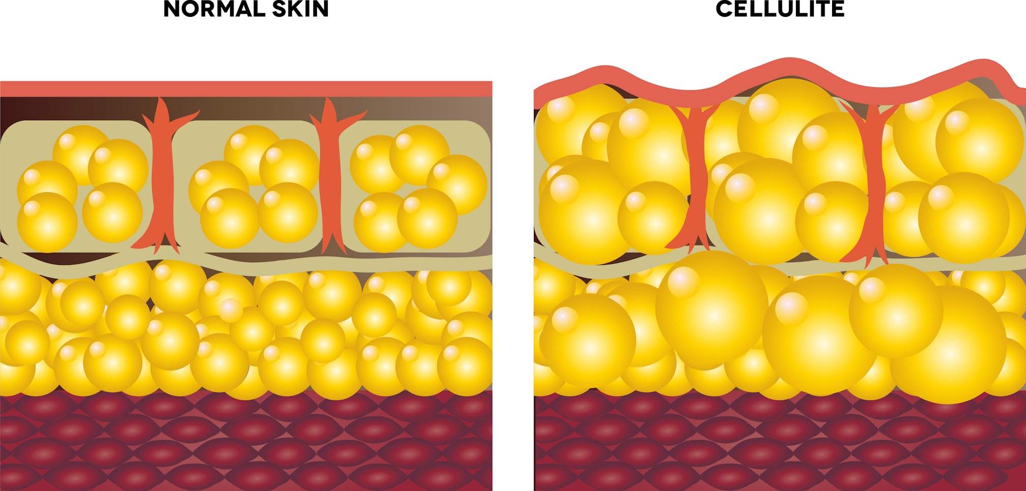 graphic showing Cellulite and normal skin depictions