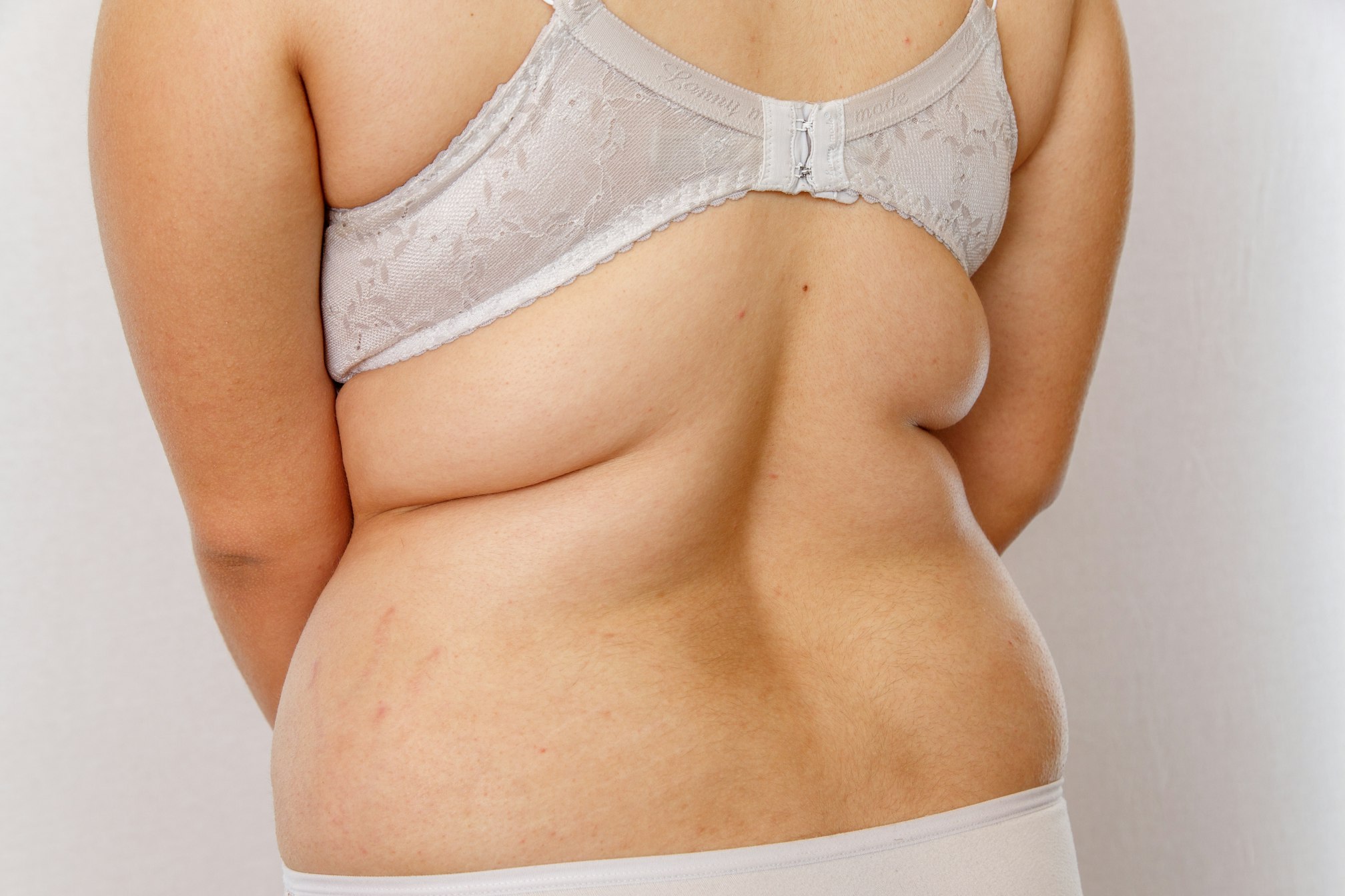 A woman's backside in a bra against a white background shows changes in the body, fat deposits on the body.