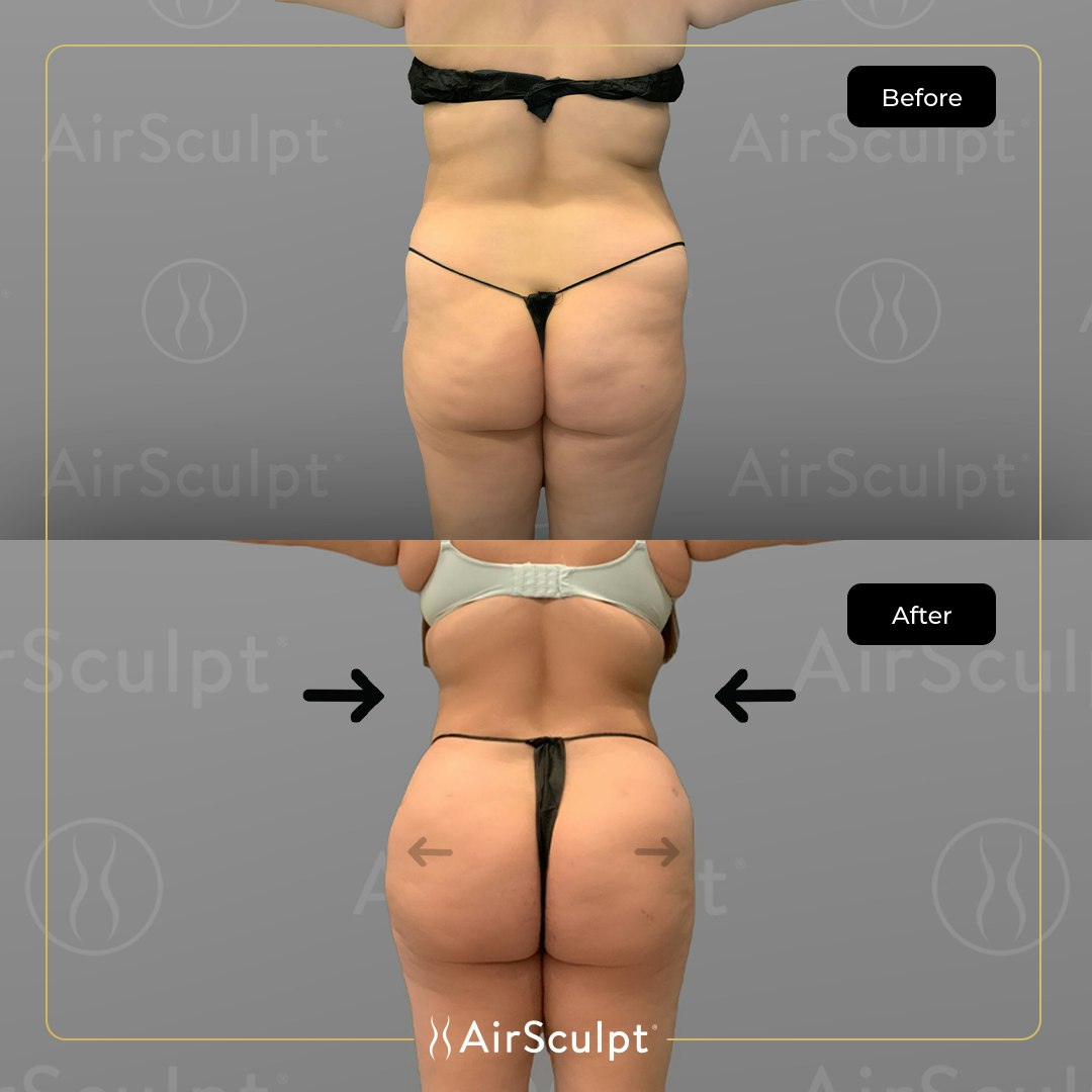 Jessica before and after airsculpt