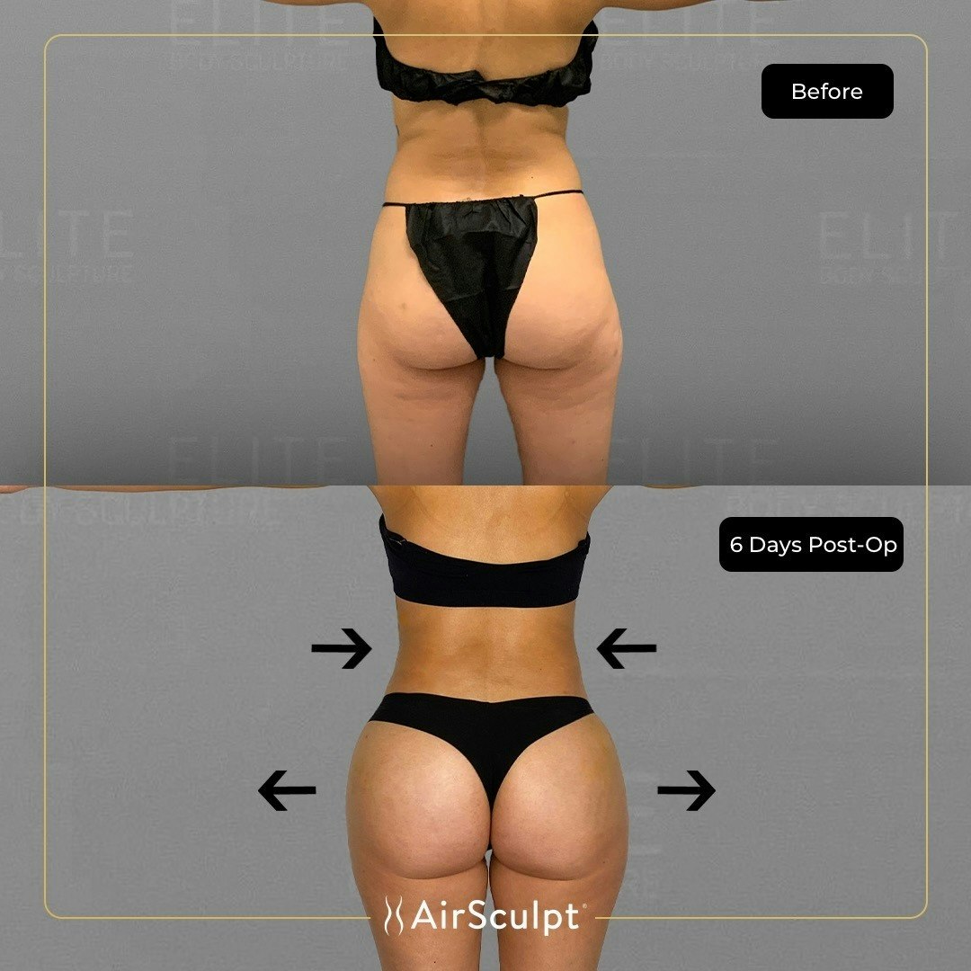 Katie Chung Ha before and after Airsculpt