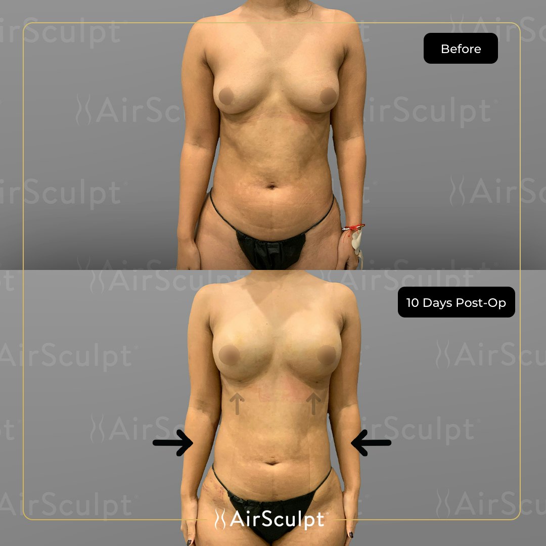Alex before and after AirSculpt