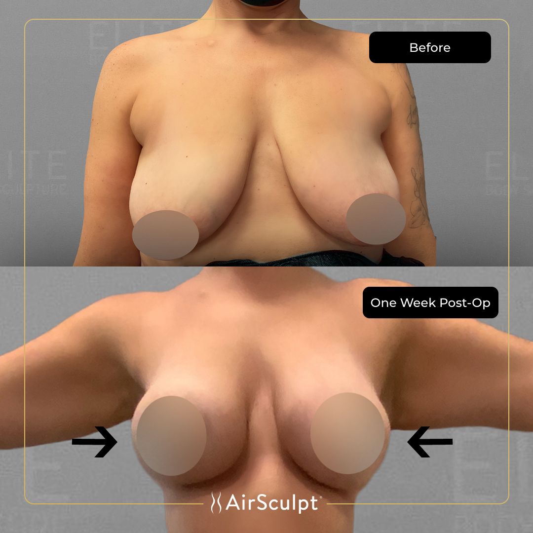 Lisa before and after Airsculpt.