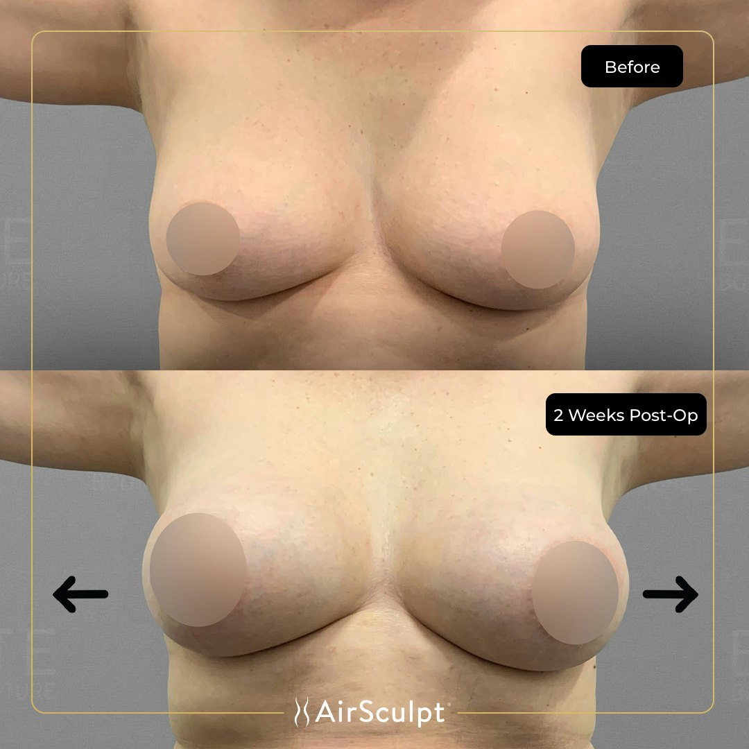 Victoria before and after airsculpt.