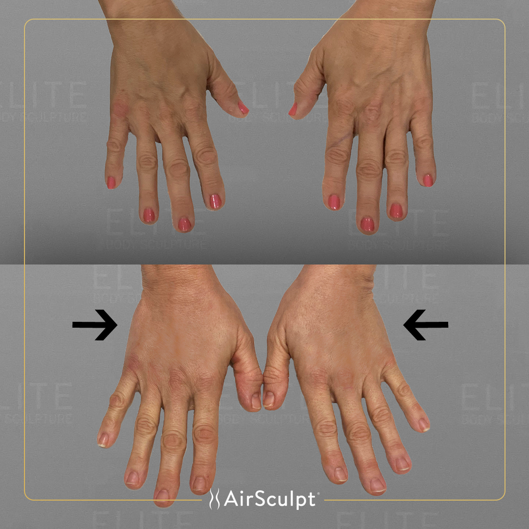 Karen before and after airsculpt