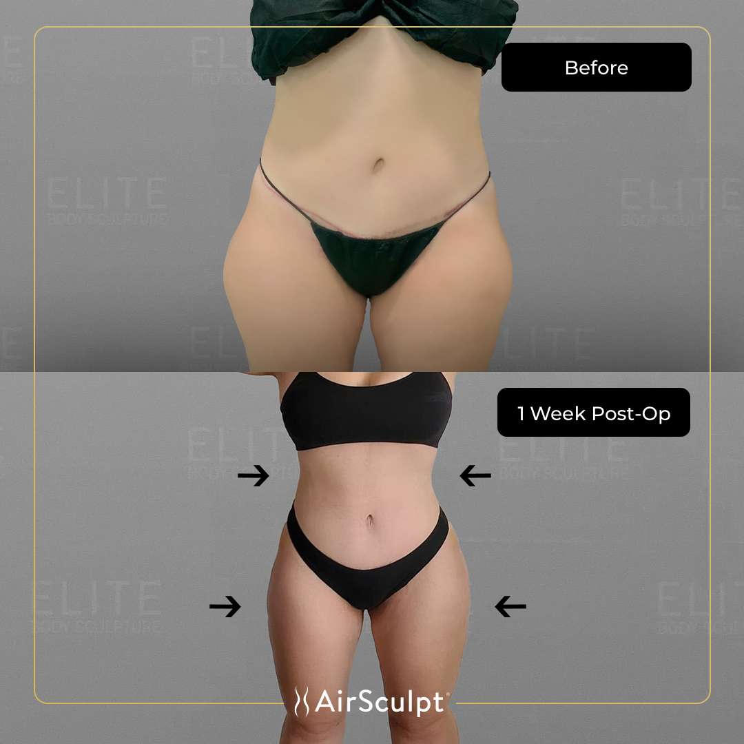 cinthia before and after airsculpt