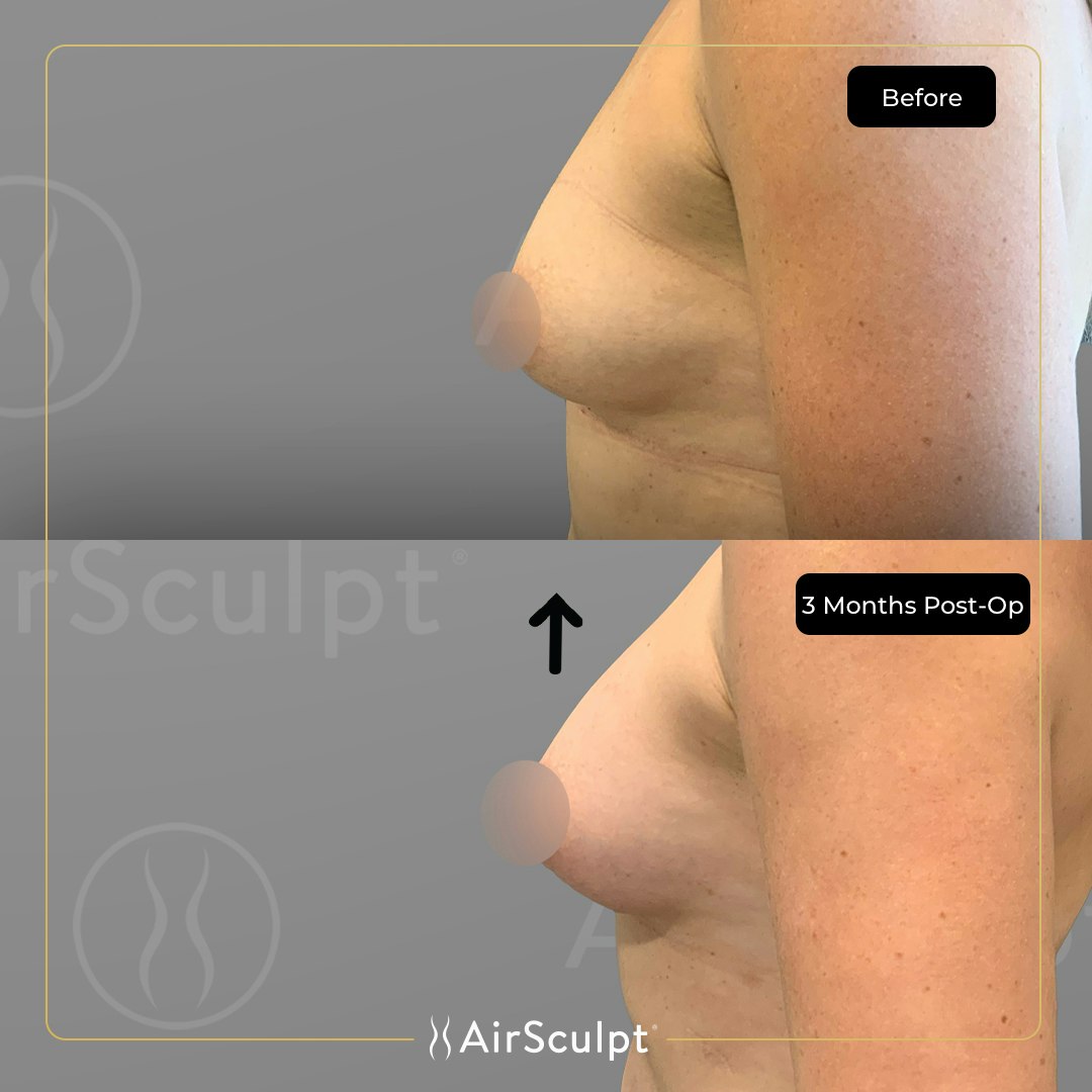 emily before and after airsculpt
