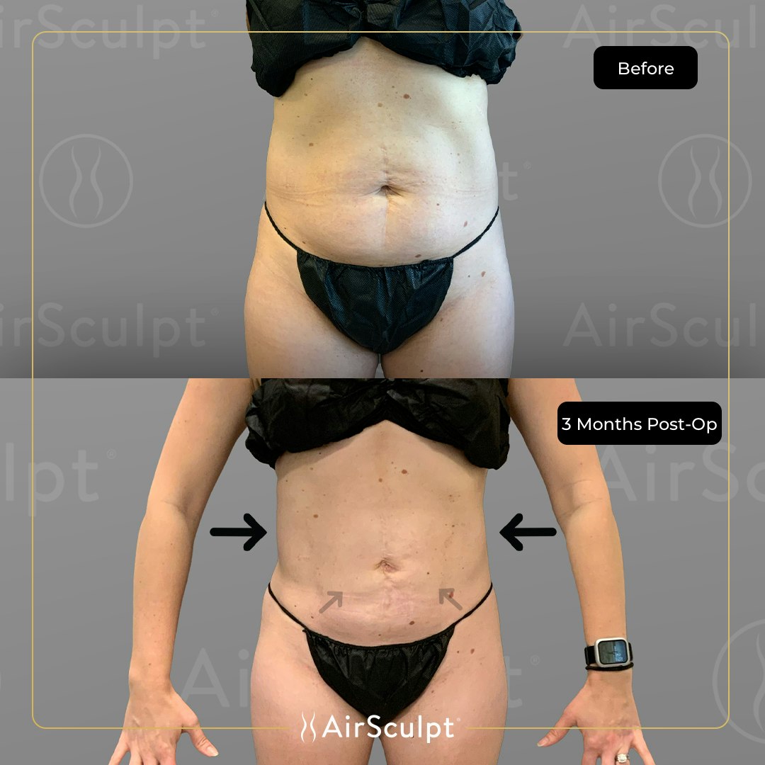 emily before and after airsculpt