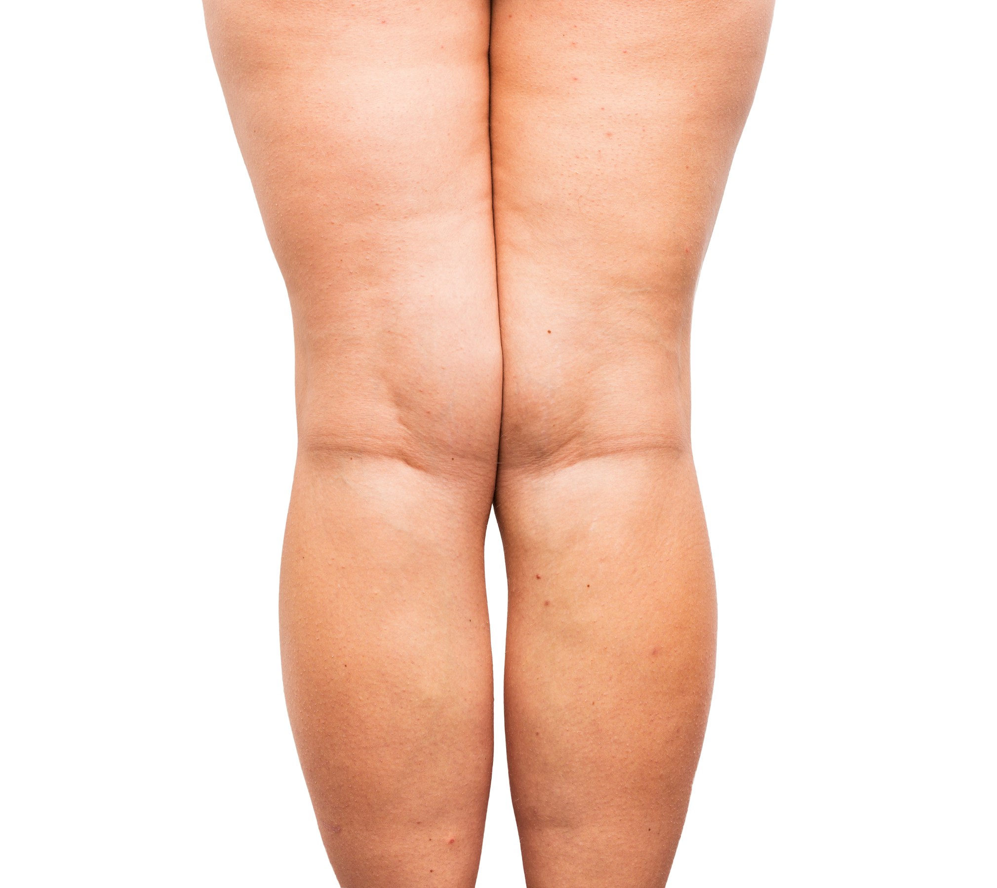image of two legs with excessive fat, knees and inner thighs touching each other