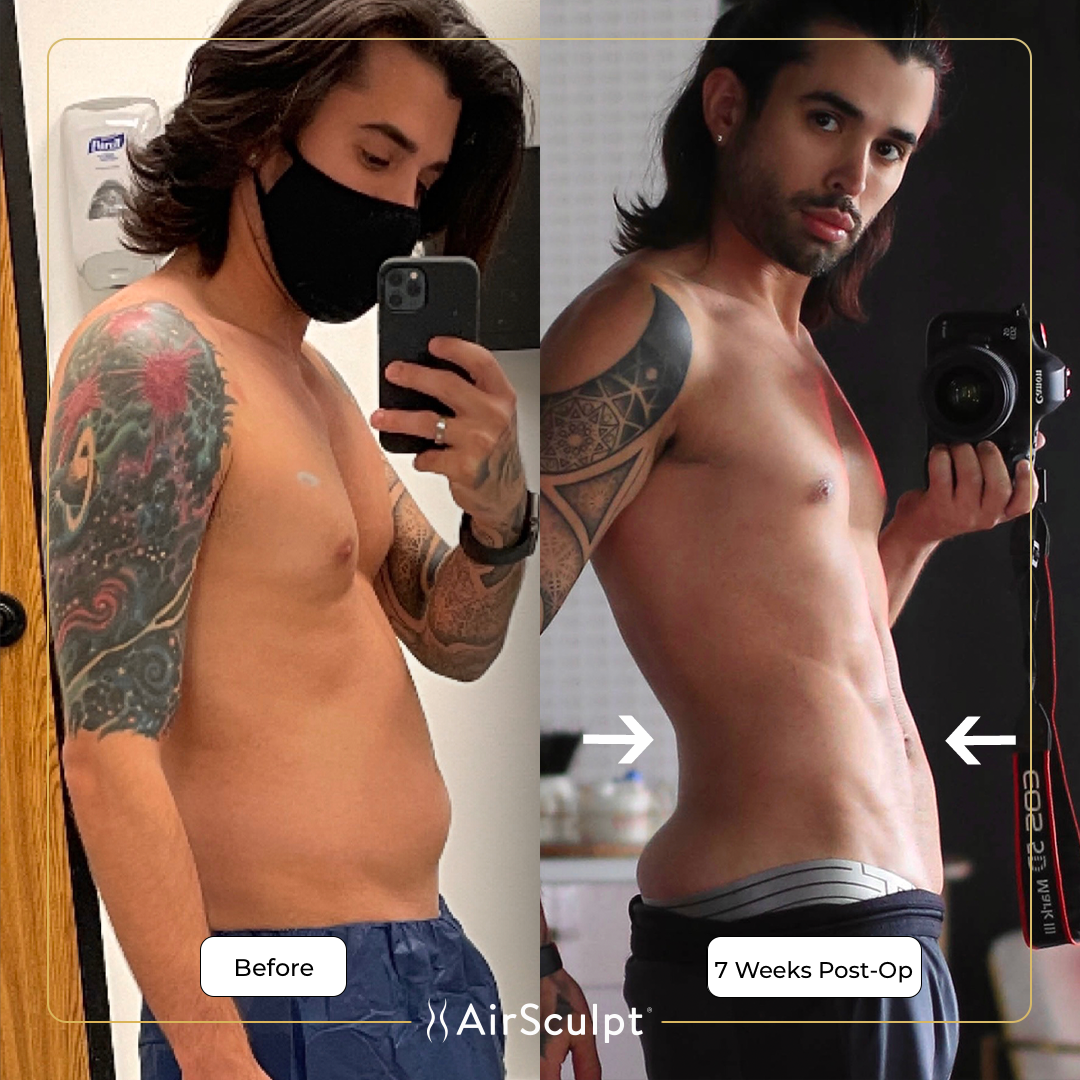 eric before and after airsculpt