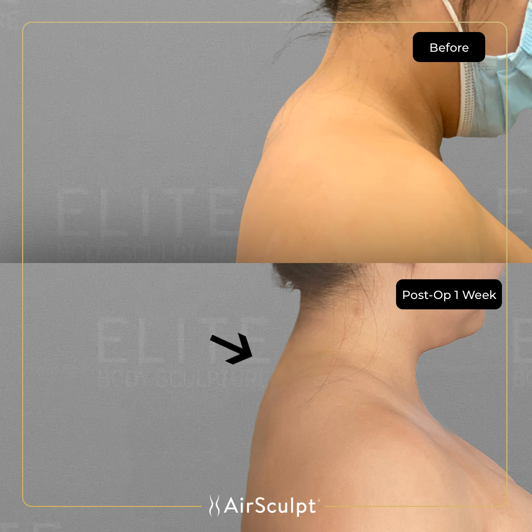 kimberly before and after airsculpt.