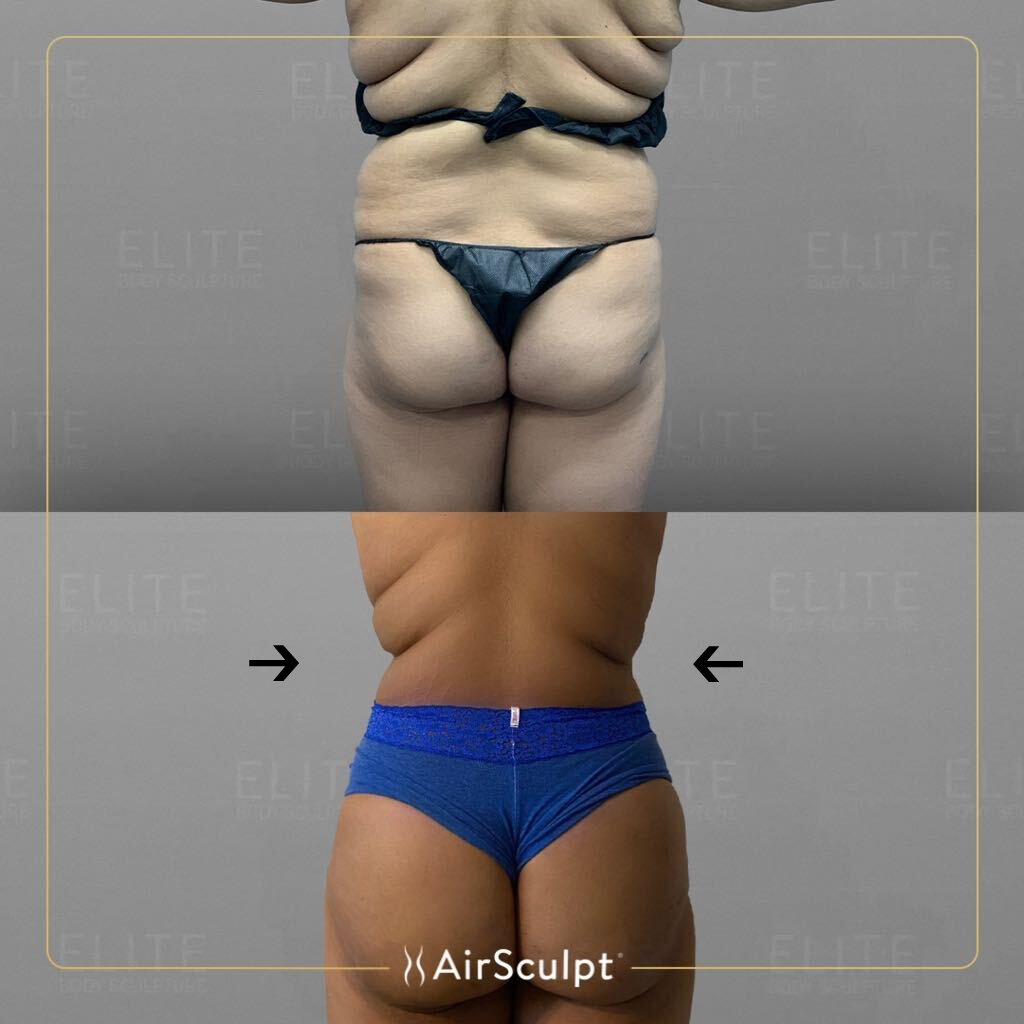 sharia before and after airsculpt
