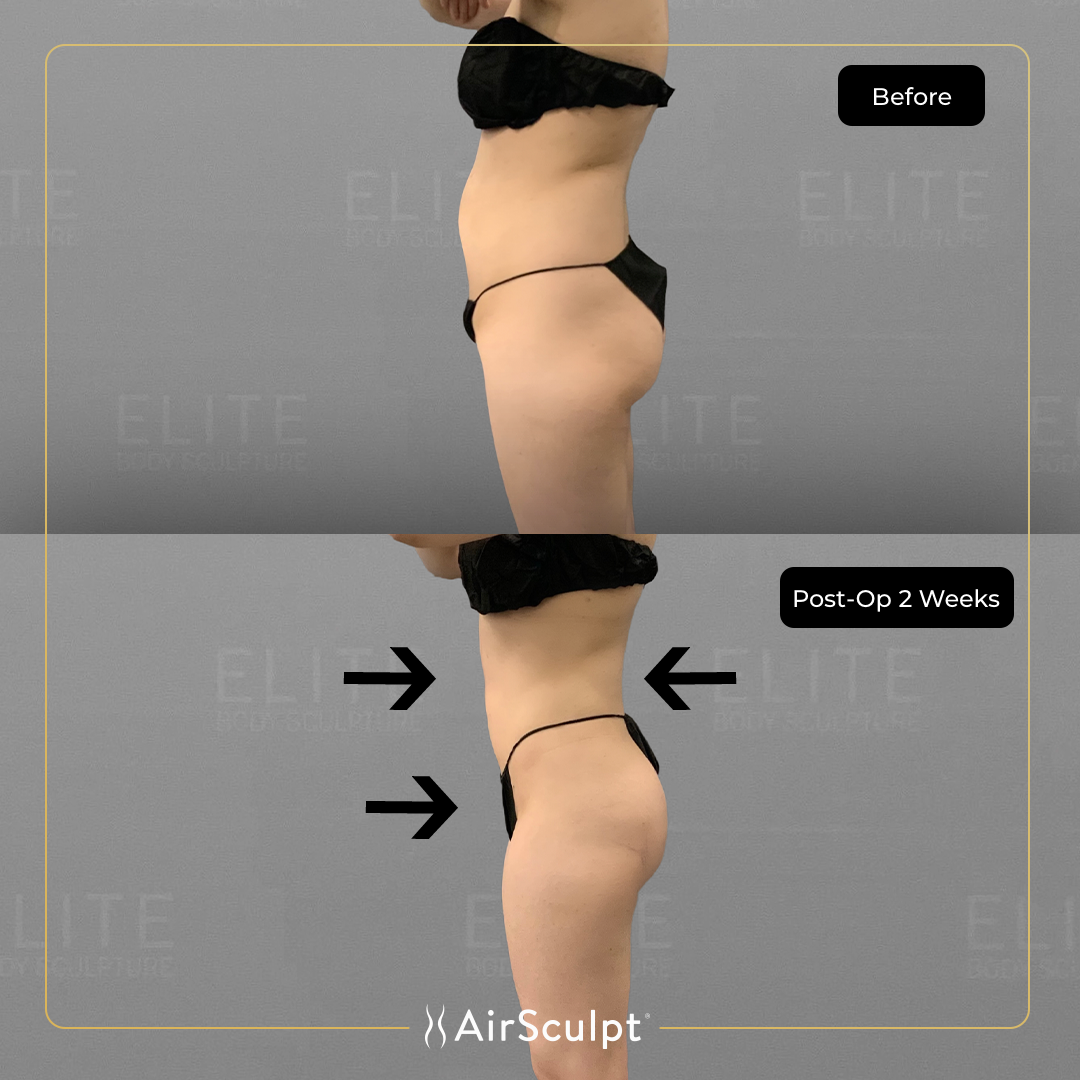 jasmine before and after airsculpt