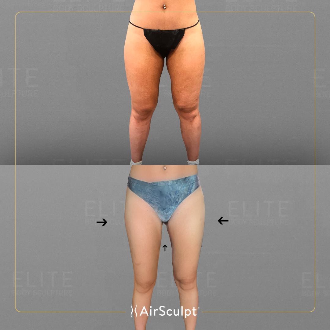 vanessa before and after airsculpt