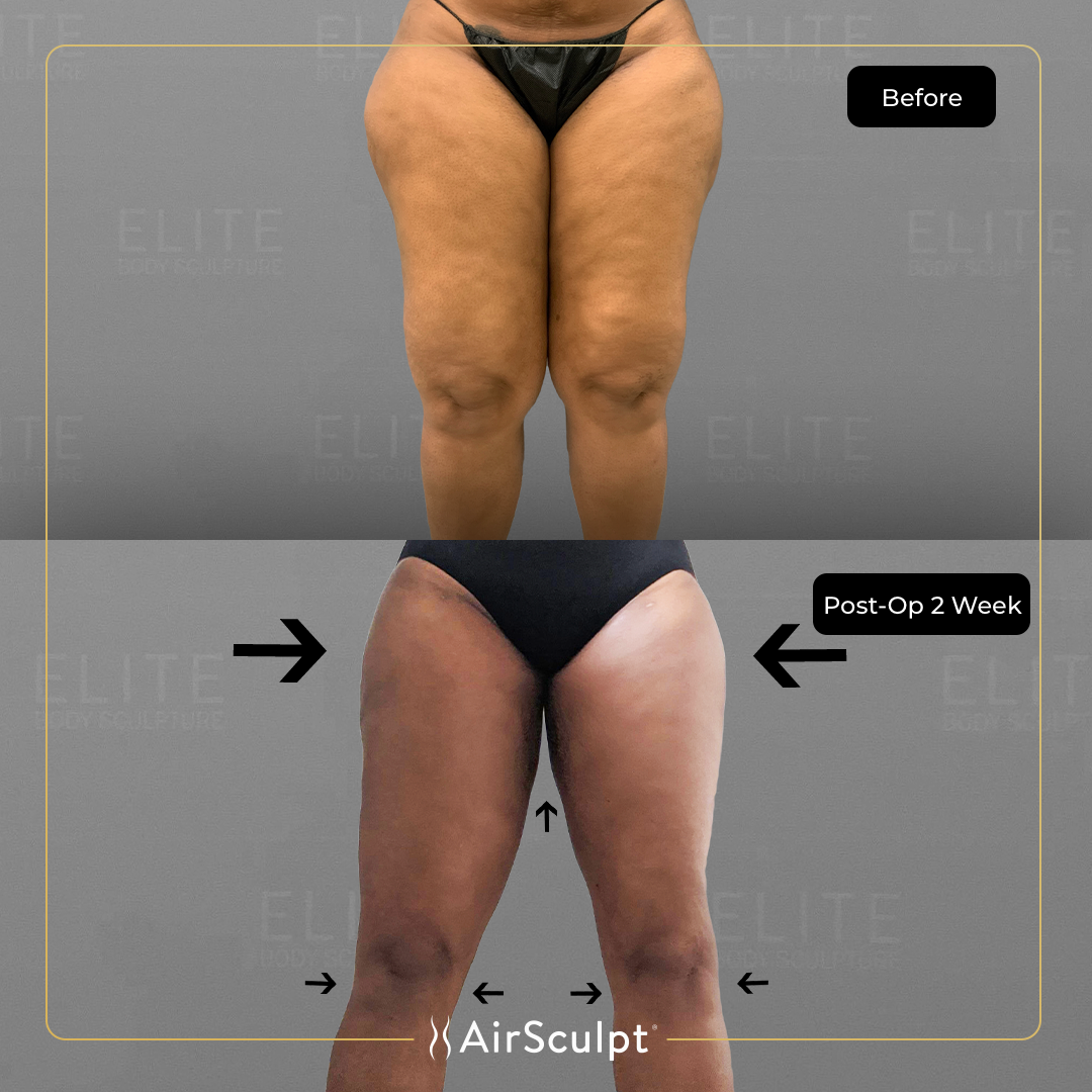 lisa before and after airsculpt