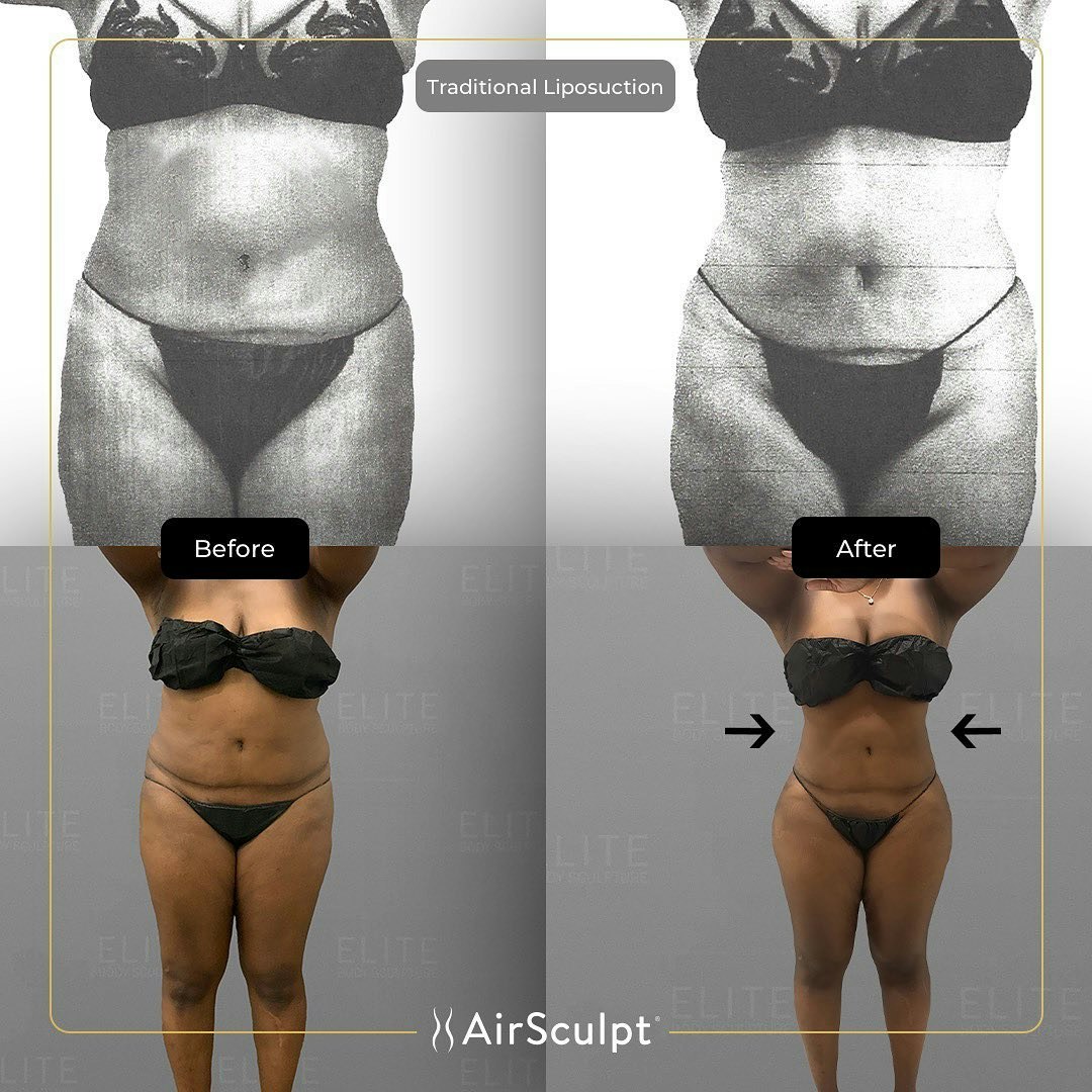 karen before and after airsculpt