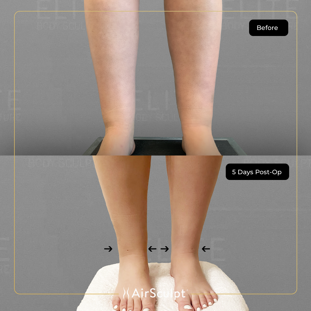 sarah before and after airsculpt.