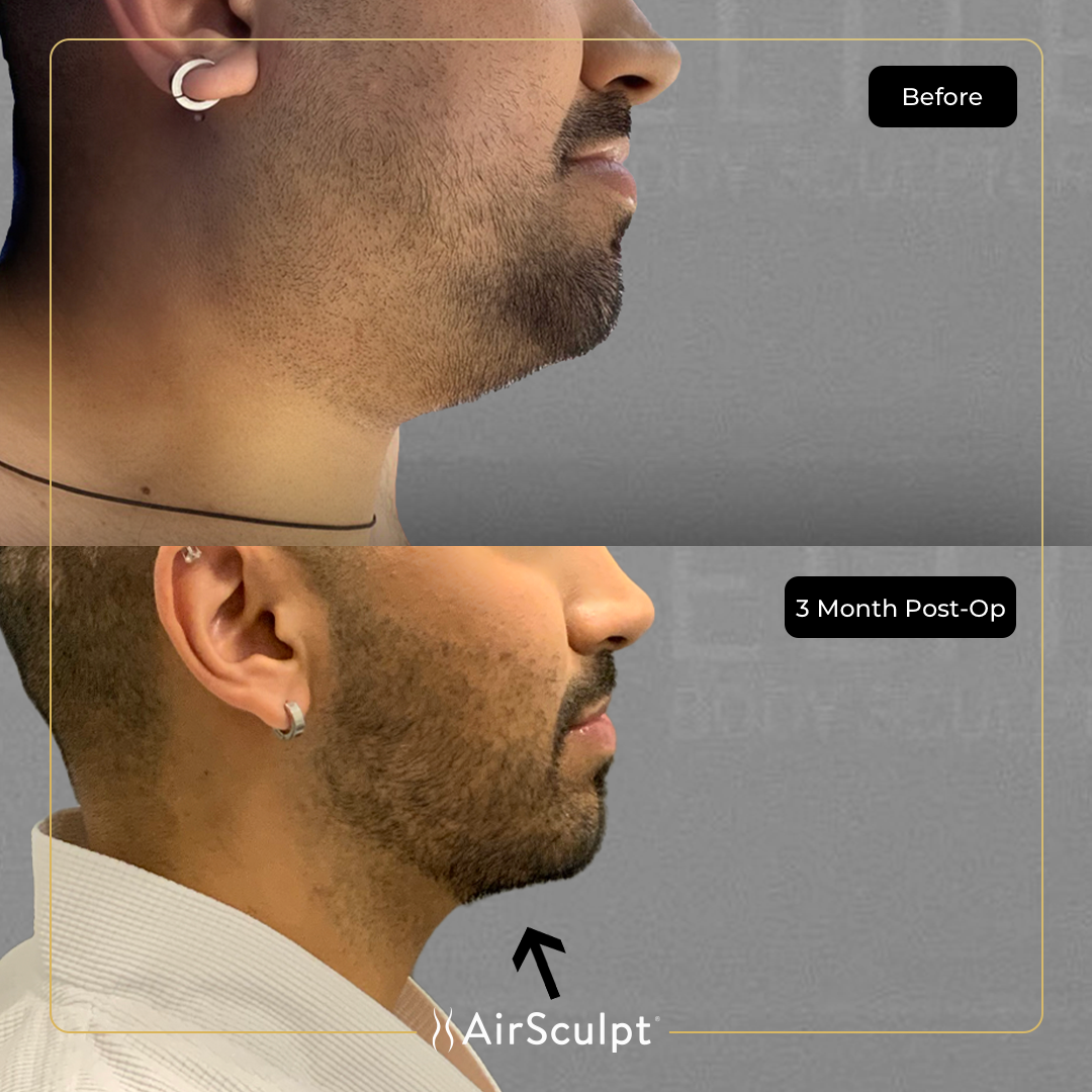 chris before and after airsculpt