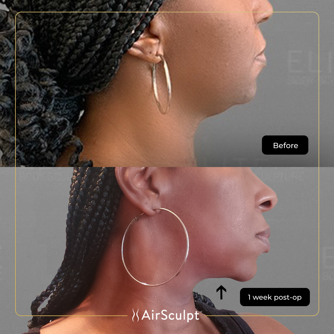 bonnie before amd after airsculpt
