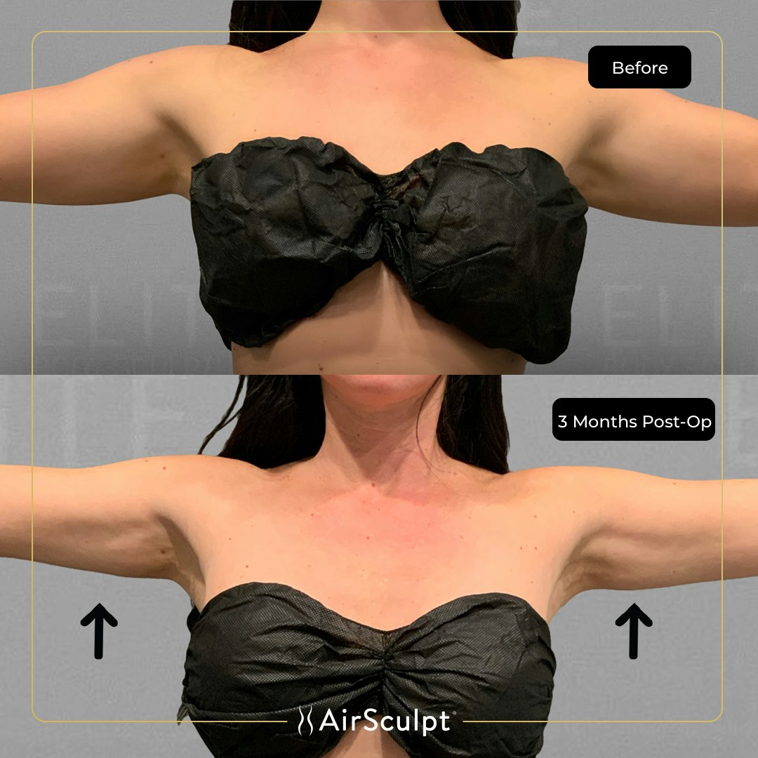 kira before and after airsculpt