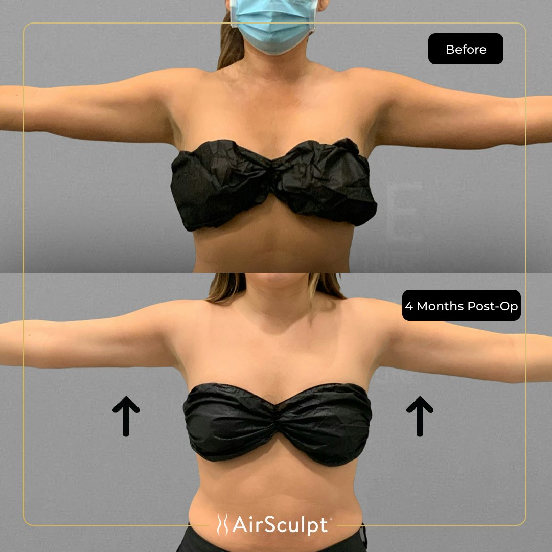 shanay before and after airsculpt