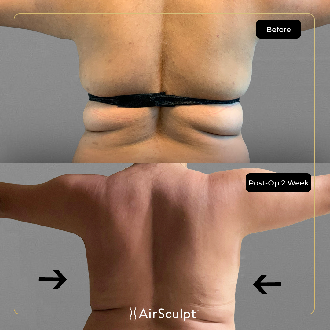 vania before and after airsculpt