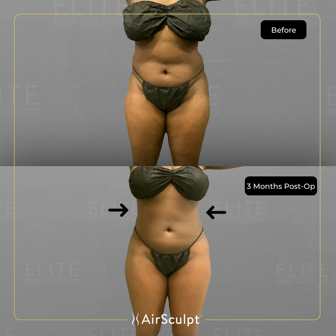idah before and after airsculpt