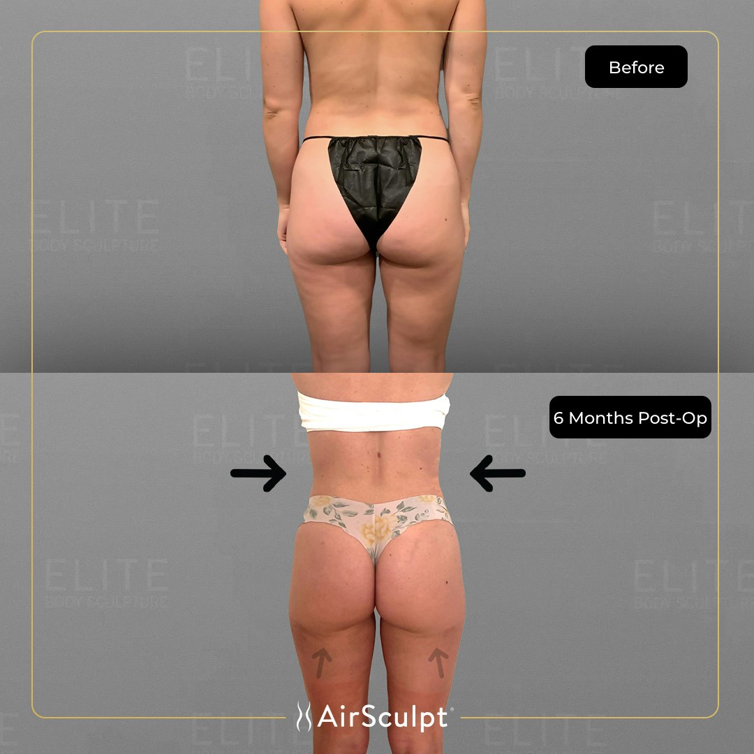 jordyn before and after airsculpt