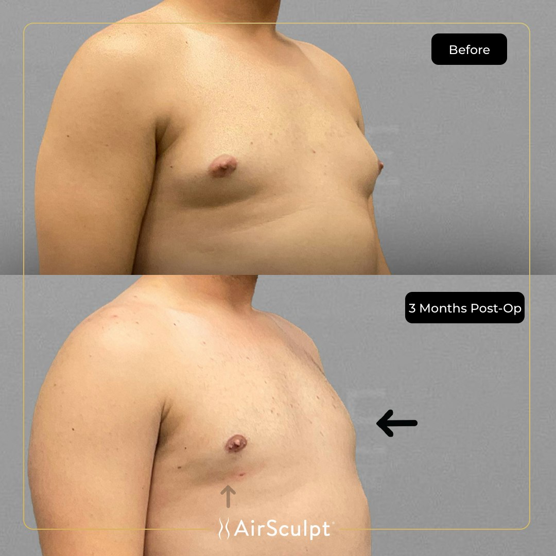 michael before and after chest airsculpt