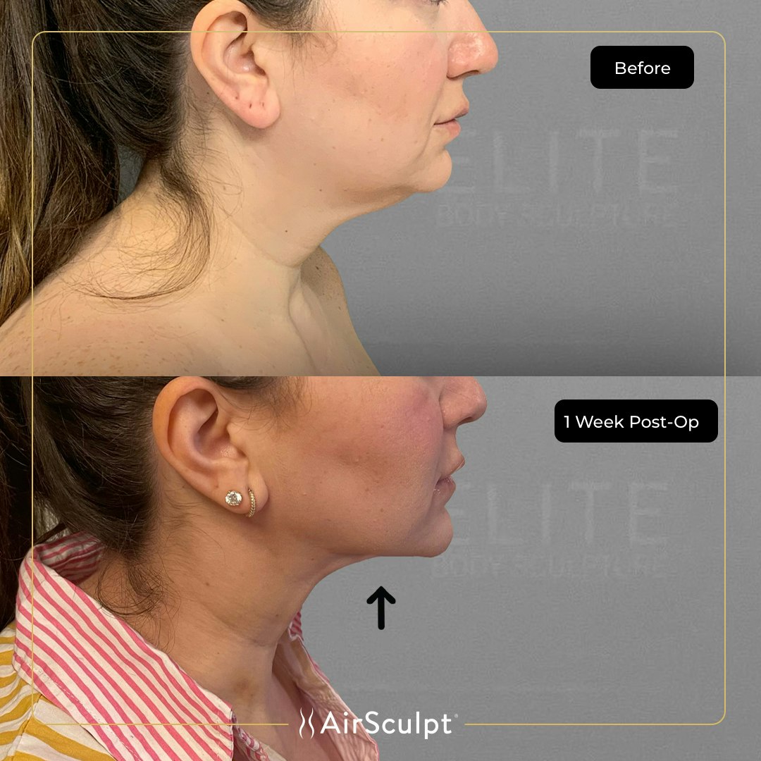 Mandy before and after chin AirSculpt