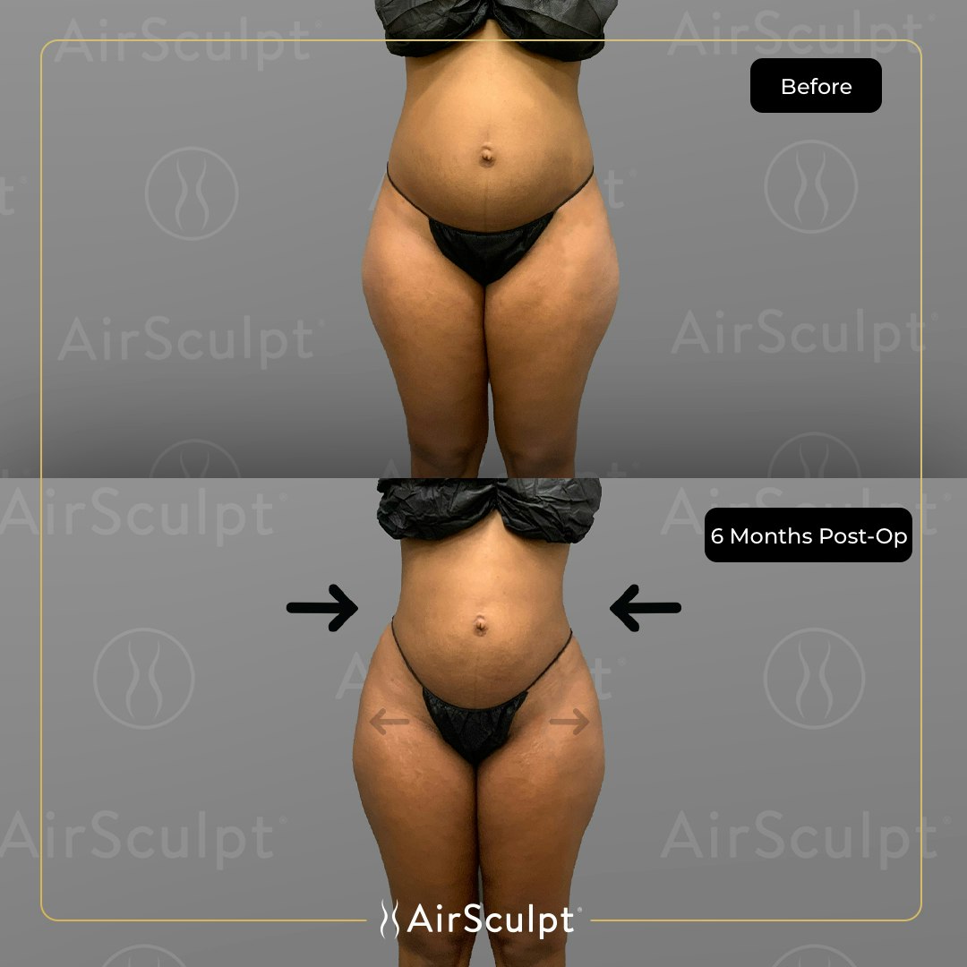 Reviewing DeLeesa Unique's Atlanta AirSculpt® Hip Flip™ Treatment