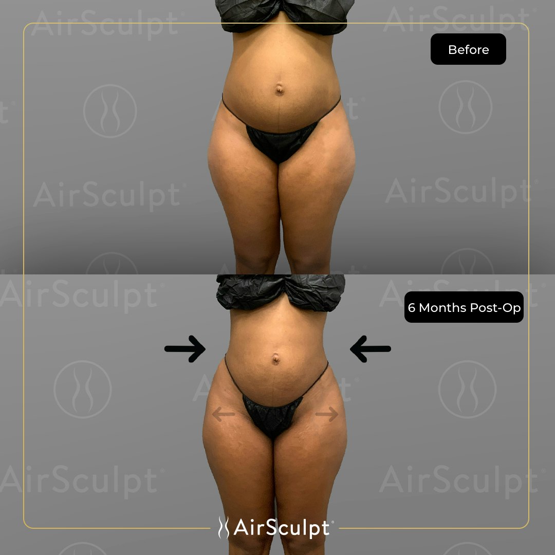 deleesa before and after airsculpt